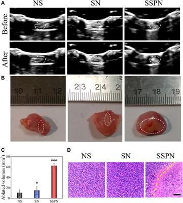 Lipid Perfluorohexane Nanoemulsion Hybrid for MRI-Guided High-Intensity Focused Ultrasound Therapy of Tumors